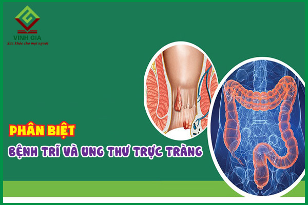Phân biệt bệnh trĩ và ung thư trực tràng