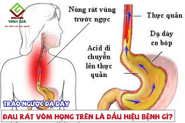 Đau rát vòm họng trên là dấu hiệu của bệnh trào ngược dạ dày thực quản