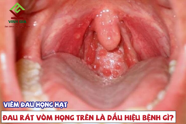 Đau rát vòm họng trên là dấu hiệu của bệnh viêm đau họng hạt