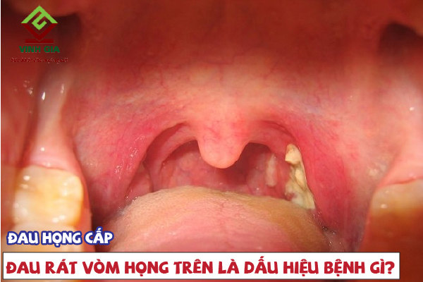 Đau rát vòm họng trên là do bệnh đau họng cấp