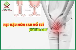 Hẹp hậu môn sau mổ trĩ: Nguyên nhân và cách điều trị