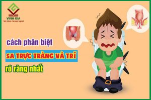 Phân biệt sa trực tràng và trĩ và cách phòng ngừa hai bệnh này