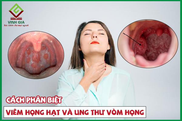 Phân biệt viêm họng hạt và ung thư vòm họng như thế nào?