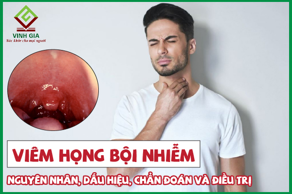 Viêm họng bội nhiễm là gì? Điều trị như thế nào tốt nhất?