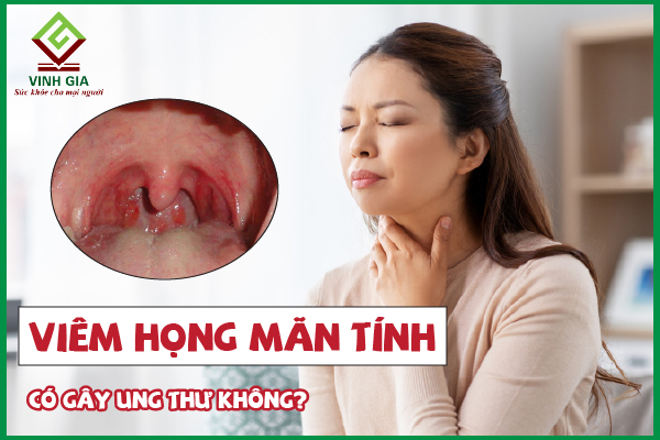 Quan tâm: Viêm họng mãn tính có gây ung thư không?