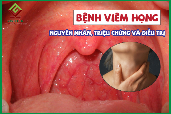 Viêm họng là gì? Nguyên nhân, triệu chứng và điều trị