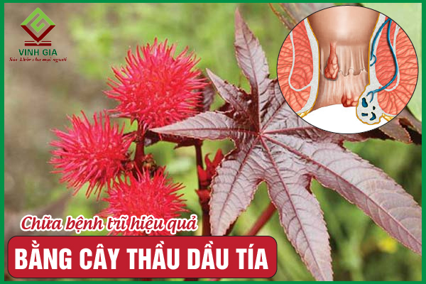 Cây thầu dầu tía làm dịu cơn đau trĩ – Không phải ai cũng biết