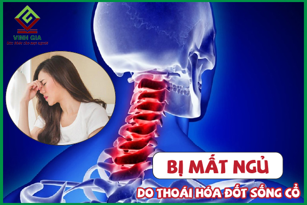 Thoái hóa đốt sống cổ gây mất ngủ: Cách khắc phục hiệu quả