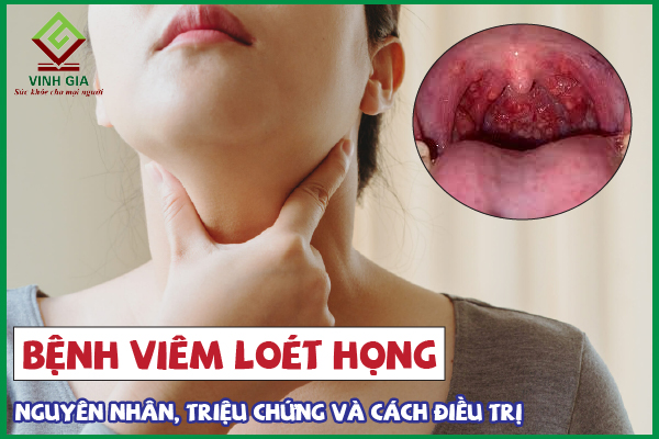 Viêm loét họng: Nguyên nhân, triệu chứng và cách điều trị