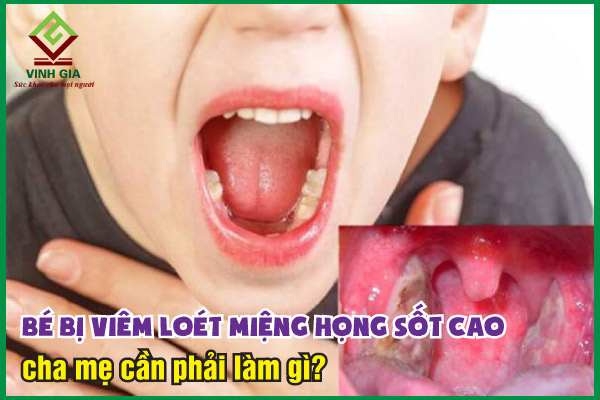 Bé bị viêm loét miệng họng sốt cao nên làm gì?