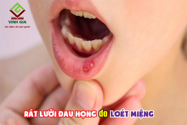 Bị đau họng rát lưỡi có thể là do bệnh loét miệng gây ra