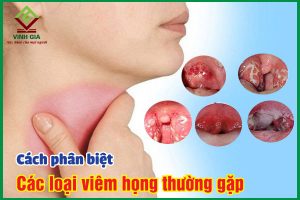 Các loại viêm họng thường gặp và cách phân biệt chính xác nhất