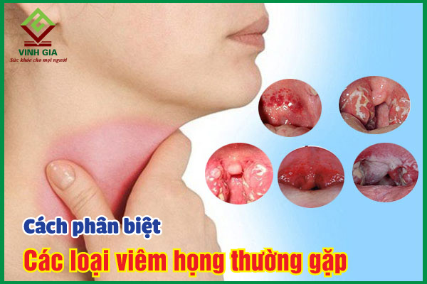 Tìm hiểu về các loại viêm họng thường gặp