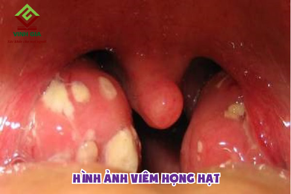 Hình hình họa viêm họng cụ thể nhất và họng bình thường