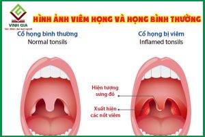 Hình ảnh viêm họng chi tiết nhất và họng bình thường