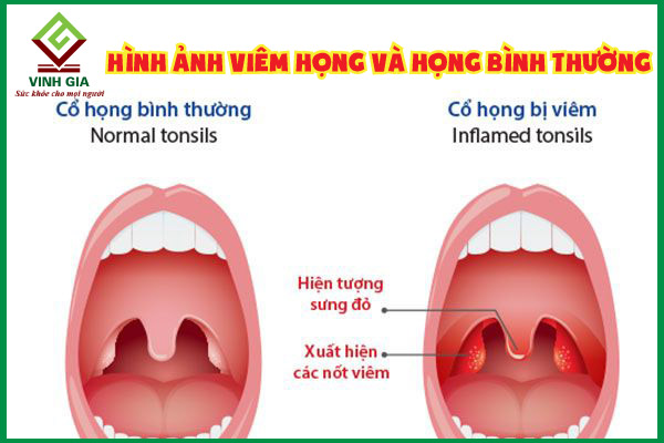 Hình hình họa viêm họng cụ thể nhất và họng bình thường