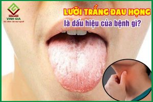 Lưỡi trắng đau họng là dấu hiệu bệnh gì? Cách chữa như thế nào?