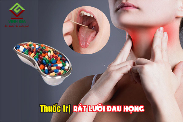 Một số loại thuốc được dùng để điều trị bệnh rát lưỡi đau họng