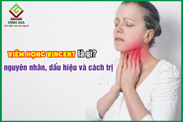 Viêm họng Vincent là gì: Nguyên nhân, triệu chứng và cách trị