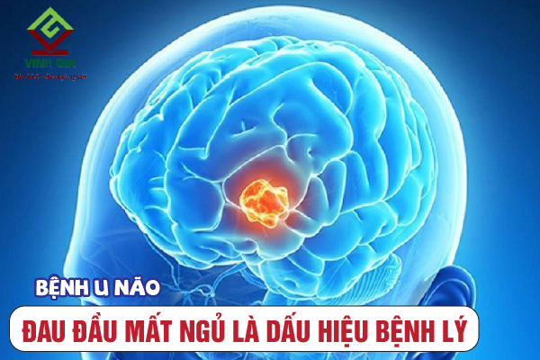 Cẩn thận khi đau đầu mất ngủ là dấu hiệu cảnh báo u não