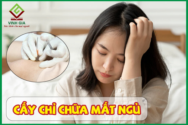 Cấy chỉ cải thiện mất ngủ: Quy trình và chi phí