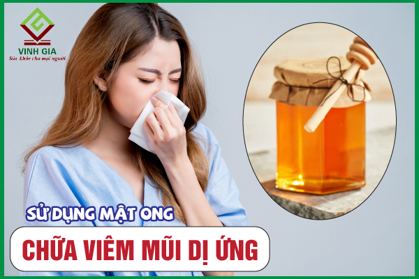 7 Cách chữa viêm mũi dị ứng bằng mật ong hiệu quả nhất