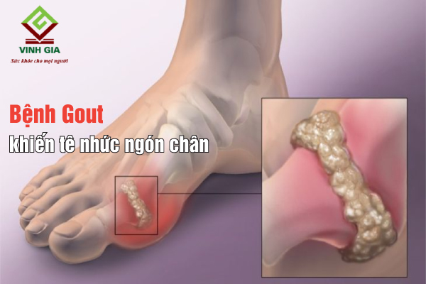 Bệnh gout thường khiến ngón chân cái bị tê nhức đau mỏi