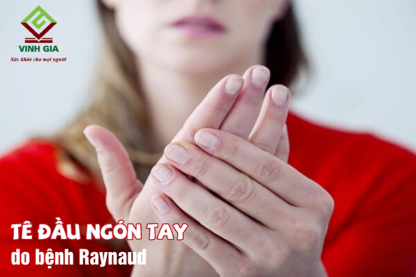 Tê bì chân tay là triệu chứng của bệnh gì? Bệnh Raynaud