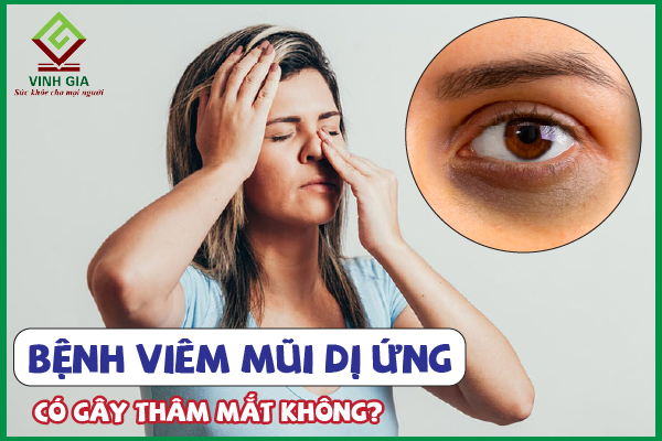 Nên làm gì khi bị viêm mũi dị ứng gây thâm mắt?