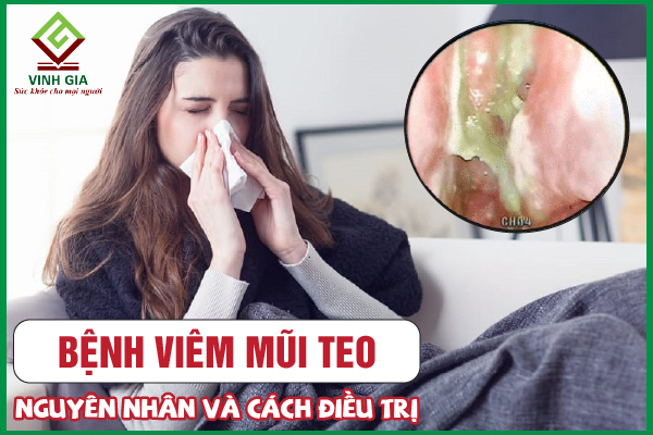 Viêm mũi teo: Nguyên nhân và cách điều trị hiệu quả