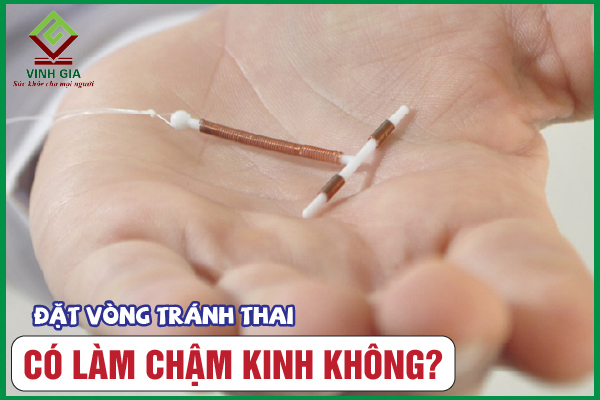 [CẨM NANG] Đặt vòng tránh thai bị trễ kinh có làm sao không?