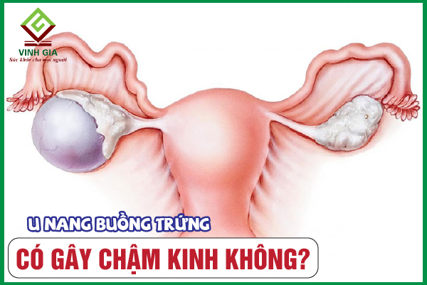 U nang buồng trứng có làm trễ kinh ở phụ nữ không?