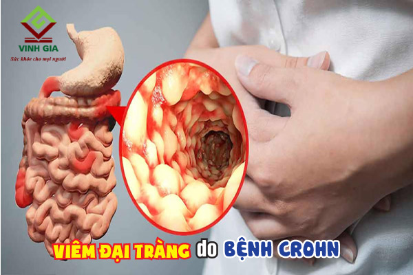 Người bị bệnh Crohn có nguy cơ cao dễ mắc bệnh viêm đại tràng