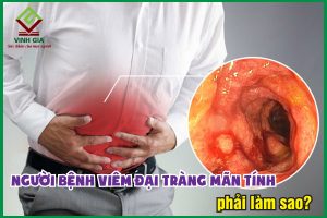 Viêm đại tràng mãn tính: Nguyên nhân và cách điều trị