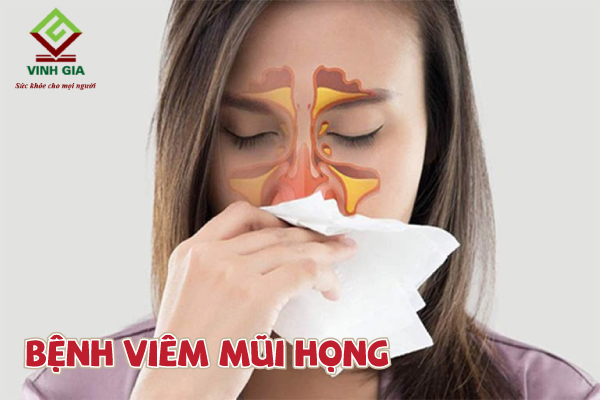 Bệnh viêm mũi họng là tình trạng viêm nhiễm của niêm mạc mũi họng