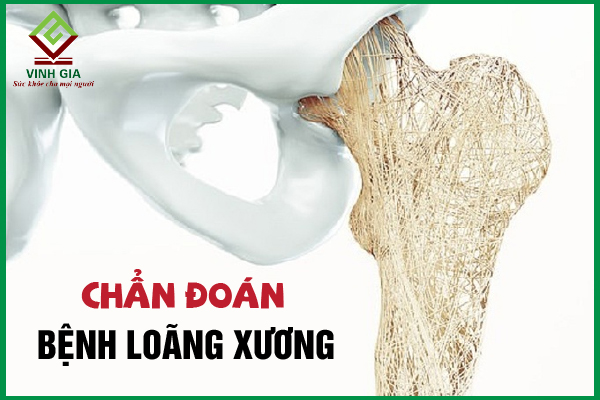 Phương pháp chẩn đoán loãng xương hiệu quả nhất hiện nay