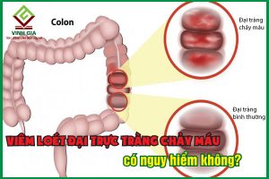 Viêm loét đại trực tràng chảy máu: Nguyên nhân, biến chứng và cách điều trị