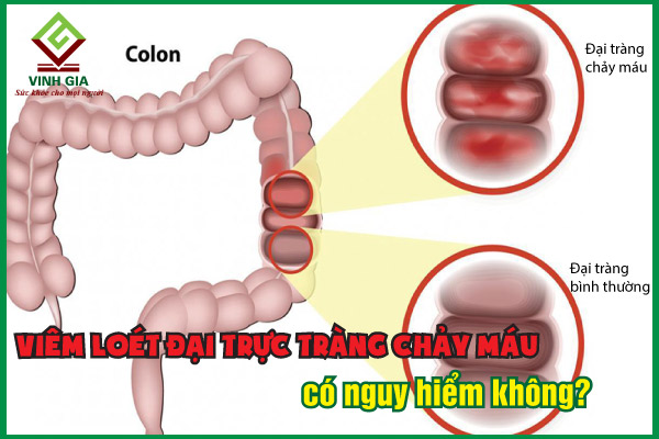 Viêm loét đại trực tràng chảy máu: Nhận biết và cách cải thiện