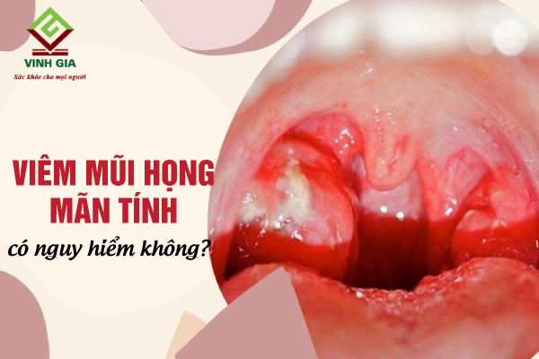 Viêm mũi họng mạn tính nếu không trị dứt điểm sẽ lan sang cơ quan khác