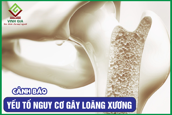 Bật mí 8 yếu tố nguy cơ gây loãng xương bạn cần tránh xa