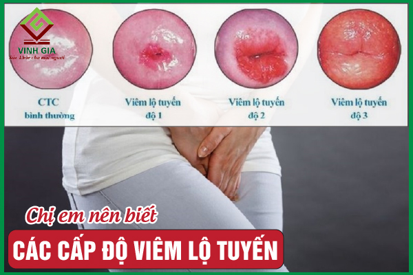 Hiểu rõ hơn về các cấp độ viêm lộ tuyến cổ tử cung