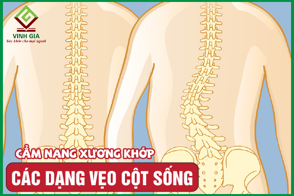 8 dạng cong vẹo cột sống thường gặp nhất hiện nay