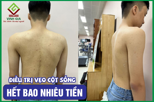 [CẨM NANG] Chi phí chữa vẹo cột sống hết bao nhiêu tiền?