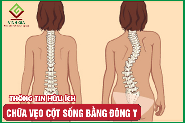 4 cách khắc phục vẹo cột sống bằng Đông y đơn giản hiệu quả