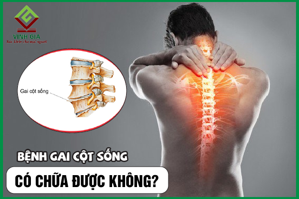 [CẨM NANG] Bệnh gai cột sống có chữa được không?