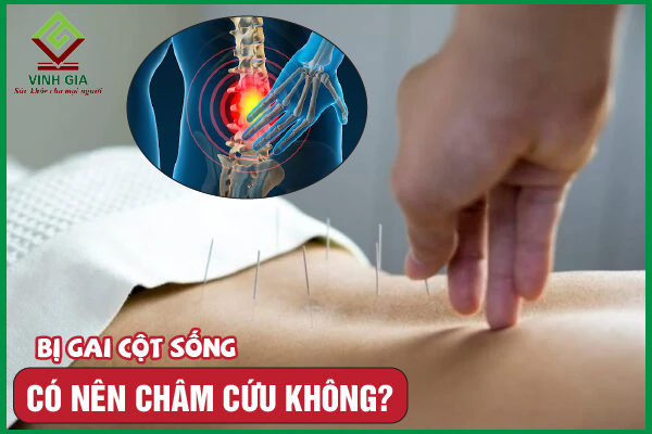 Châm cứu khắc phục gai cột sống liệu có thực sự hiệu quả?