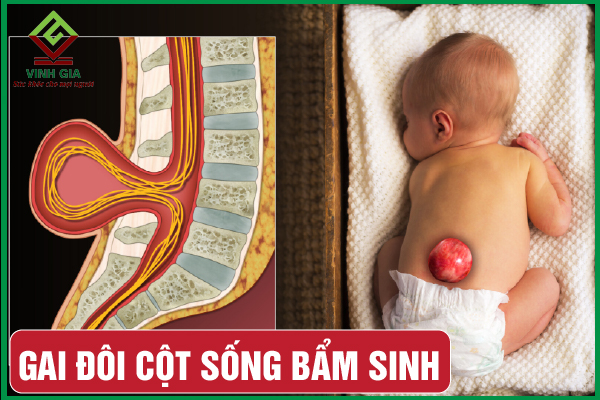 Gai đôi cột sống bẩm sinh: Chứa đựng nhiều nguy hiểm!