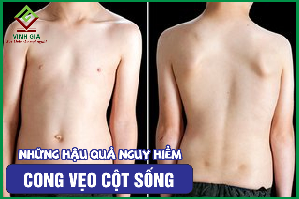 Những hậu quả khủng khiếp của cong vẹo cột sống