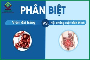 Phân biệt 2 bệnh lý: Viêm đại tràng và hội chứng ruột kích thích