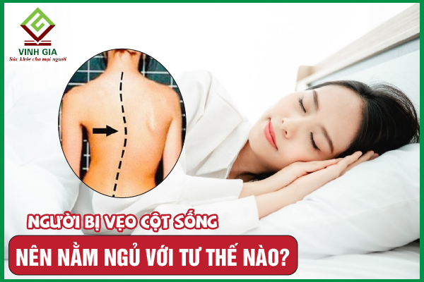 Gợi ý 3 tư thế nằm cho người vẹo cột sống tốt nhất